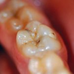 Восстановление жевательных и боковых зубов