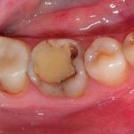 Secondary caries