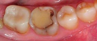 Secondary caries