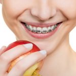 Choosing braces. Which systems are better to install? 