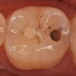 Filling fell out of tooth