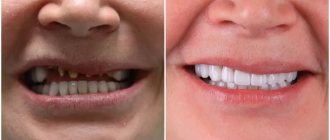 Due to the fact that we remove wear on the lower teeth, people change. How do they change? - they, as a rule, begin to take care of themselves more, they see how they look younger, how their face has changed 