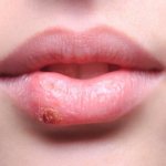 Заболевание губ