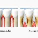 Healthy teeth and periodontitis in pictures