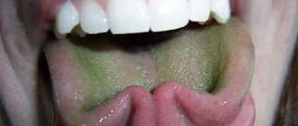 Green coating on the tongue