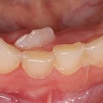 Tooth-grows-second-row1.jpg