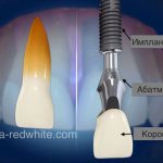 dental implant, dental implants, implants Tver