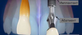 dental implant, dental implants, implants Tver