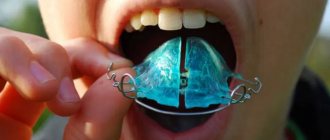 Зубные пластины для детей лучше брекетов? – ортодонт Рягузова Елена, Москва