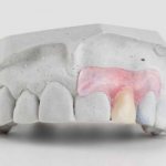 Зубные протезы «Бабочка» нового поколения