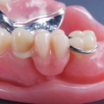 Зубные протезы из акриловой пластмассы. Преимущества и недостатки