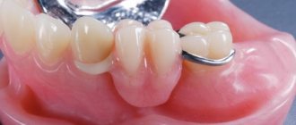 Зубные протезы из акриловой пластмассы. Преимущества и недостатки