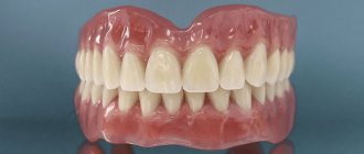 зубные протезы на присосках при полном отсутствии зубов